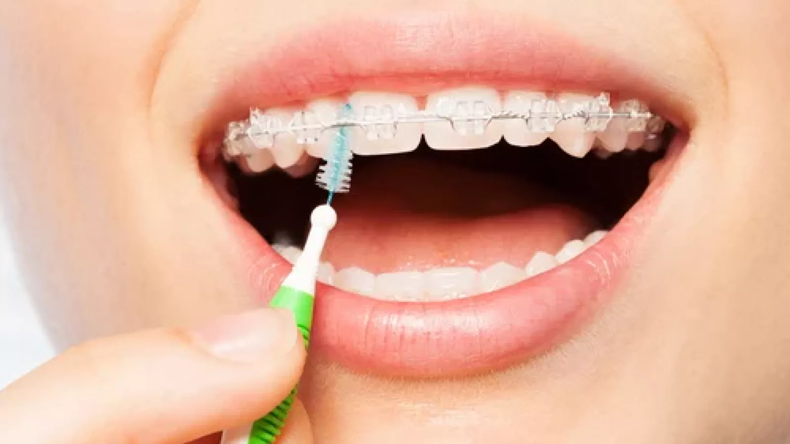 Appareils dentaires : GUM lance des comprimés pour leur entretien