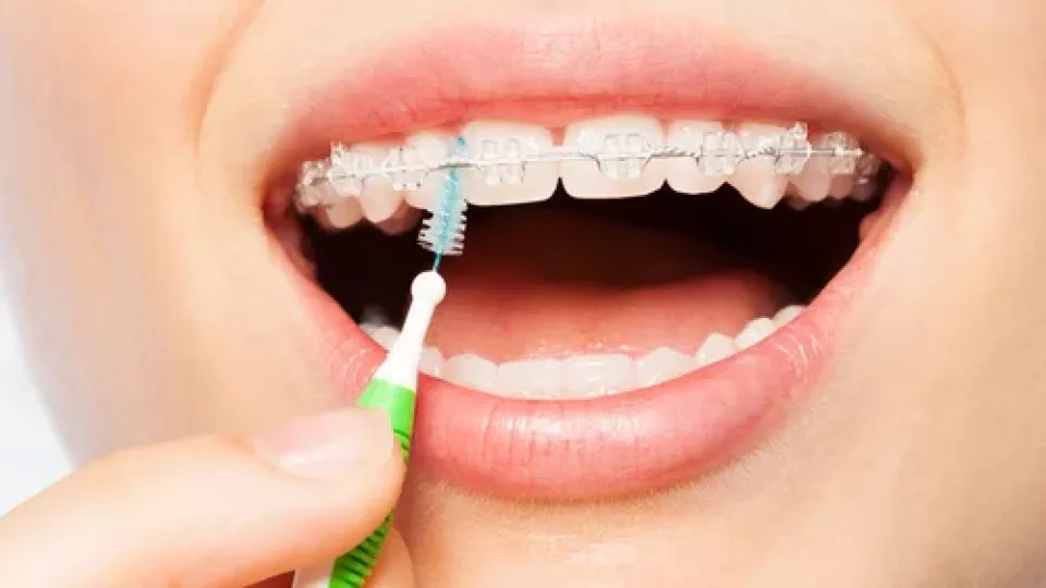 Appareils dentaires : GUM lance des comprimés pour leur entretien